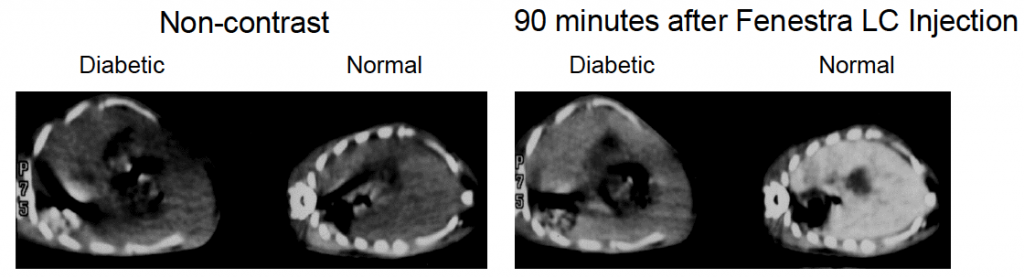 Fenestra LC Diabetes